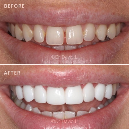 Before and After for Porcelain Veneersn